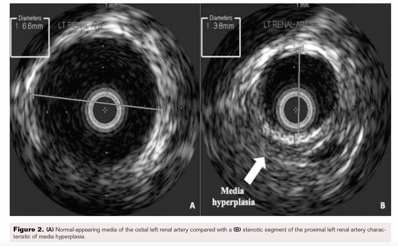 Unilateral Renal Artery Stenosis with Unusual Etiology VDM
